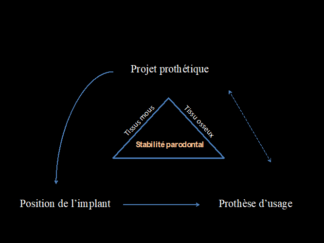 La prothèse unitaire sur implant