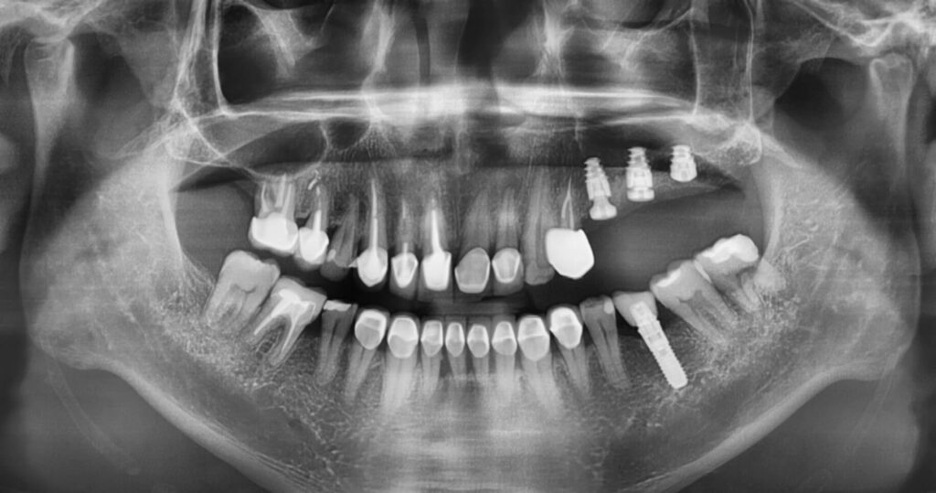 Pose de 3 implants courts au maxillaire, secteur #2