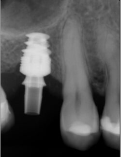 Implants court et sinus