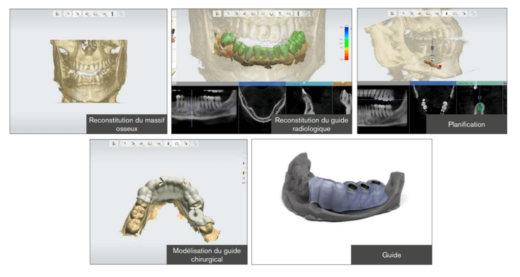 Planification implantaire en chirurgie guidée complète