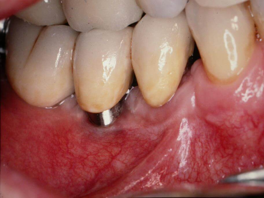 Inflammation de la gencive J0