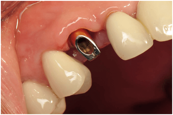 Pilier prothétique sur implant