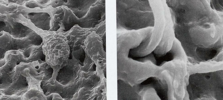 Trabéculations osseuses