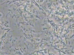 Visualisation du biofilm chez un patient présentant une péri-implantite