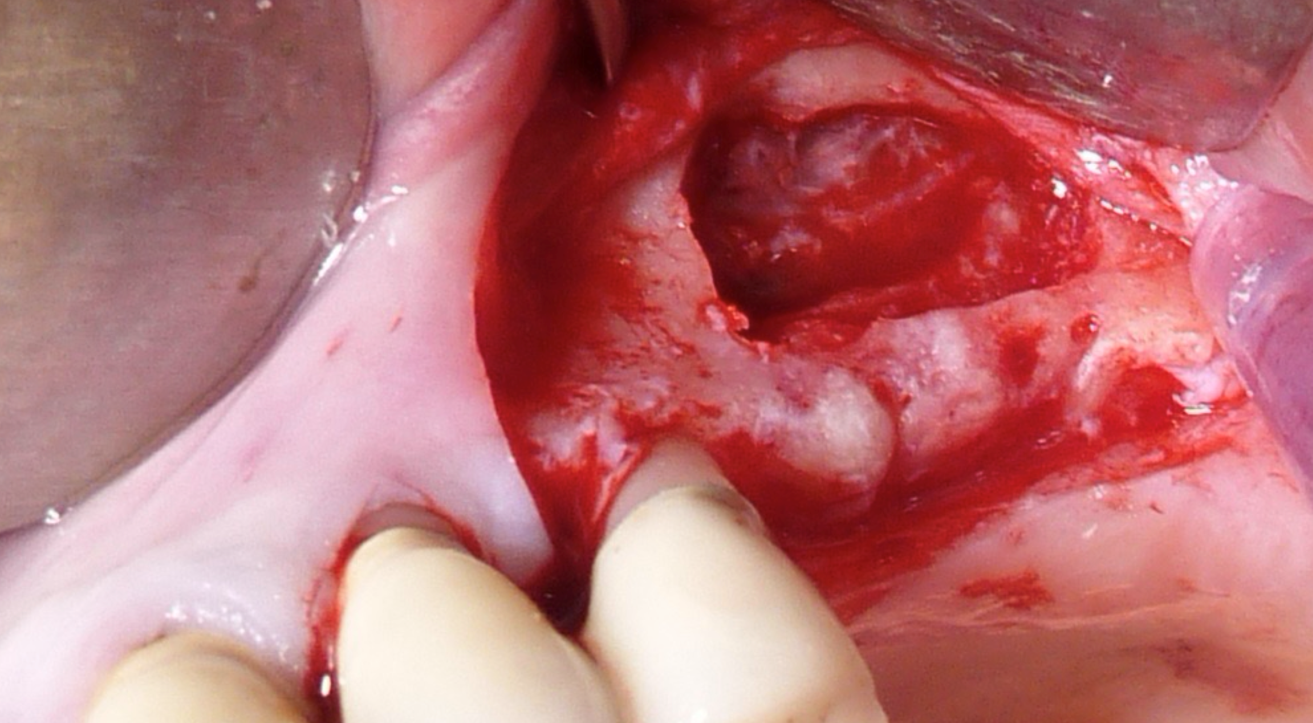 AMENAGEMENT DU SINUS MAXILLAIRE