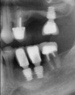 Implants courts mandibule et maxillaire