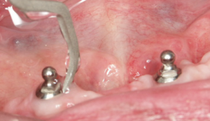 Intérêt des inserts carbone pour la maintenance implantaire (ici un insert PH1 Satelec)