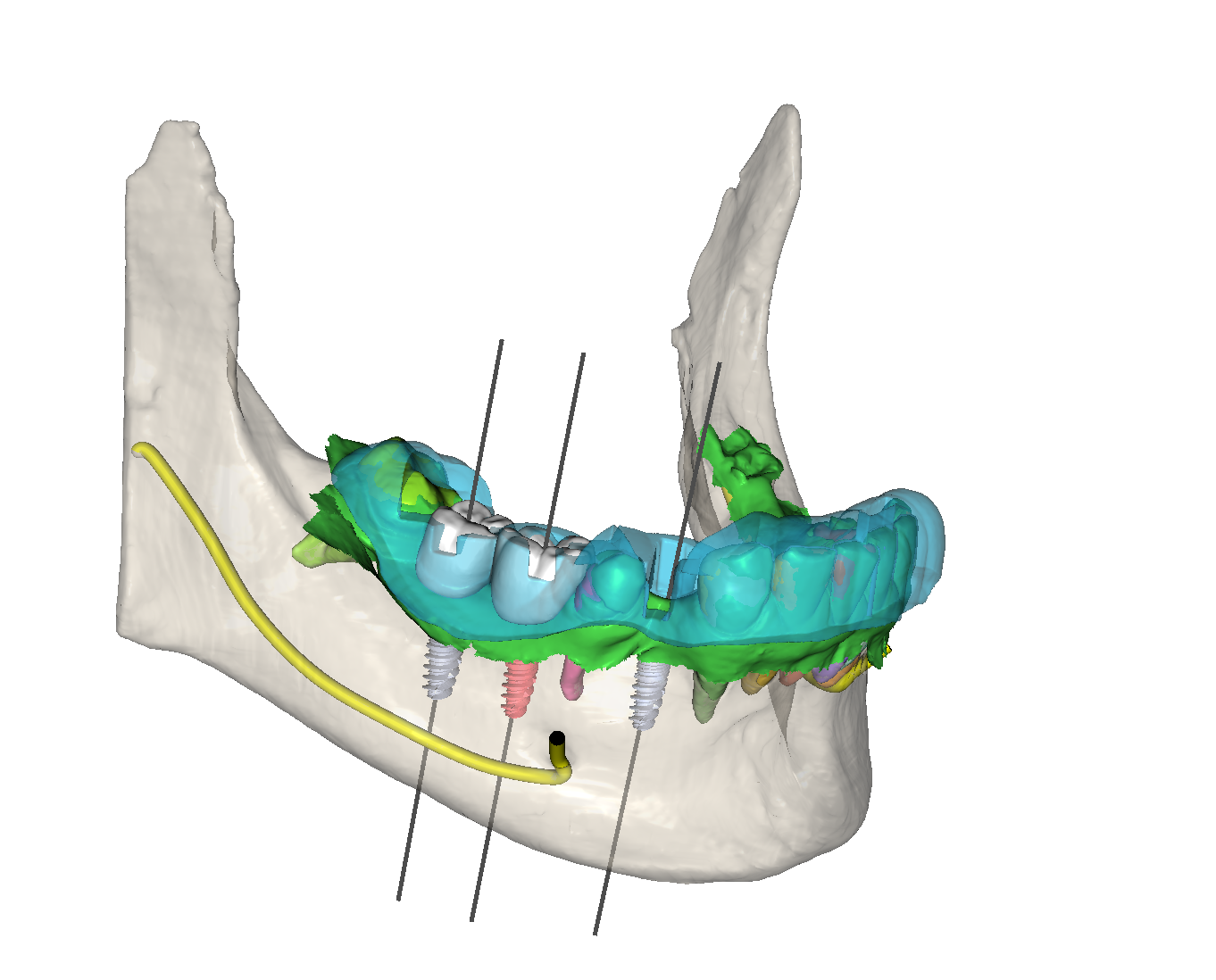 Chirurgie guidée : maîtriser la planification implantaire et la réalisation de guide