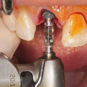 Extraction implantation : étapes clés et facteurs de succès