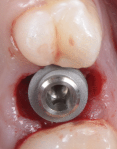 Implantologie : restez conservateur !