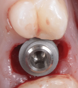 Implantologie : restez conservateur !