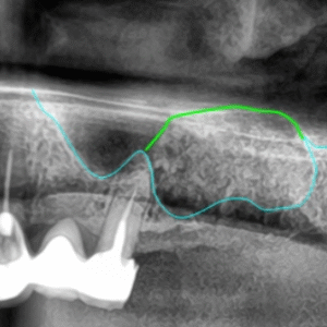 Les greffes de sinus : commencez demain au cabinet !