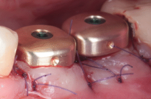 Prise en charge parodontale et gestion des tissus mous