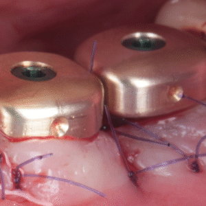 Prise en charge parodontale et gestion des tissus mous